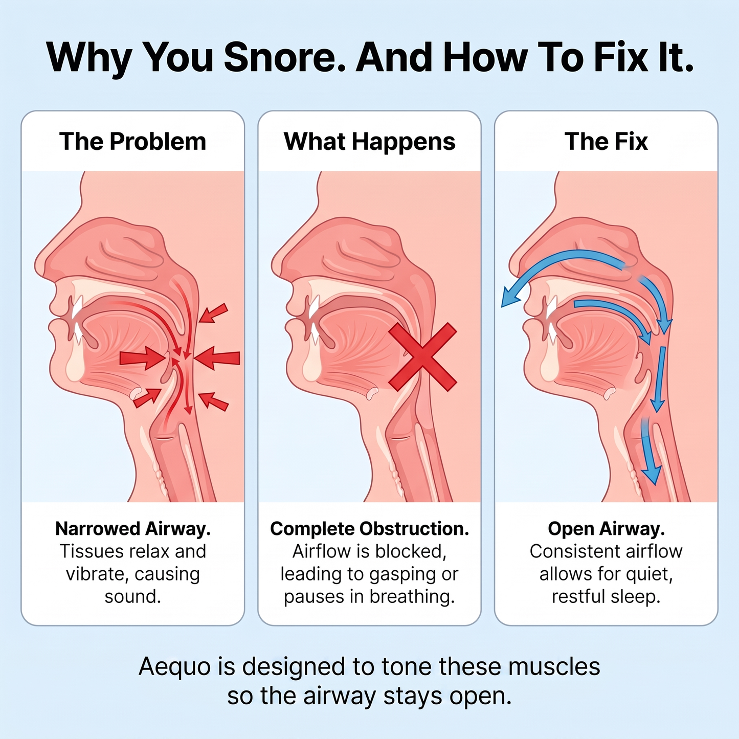Aequo — Anti-Snoring Device, No Mask or Mouthpiece